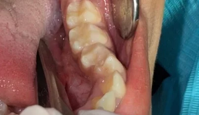 بعد علاج الأسنان في مجمع أيار السابع الطبي جازان